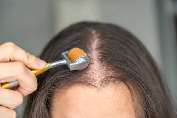 non-surgical hair loss treatment New Jersey