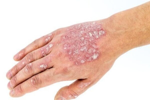 What Are Your Options for Squamous Cell Carcinoma Treatment in Costa Mesa CA? A Friendly Guide with Tips on Actinic Keratosis Treatment squamous cell Carcinoma treatment Costa Mesa CA