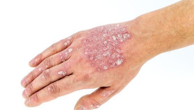 squamous cell Carcinoma treatment Costa Mesa CA