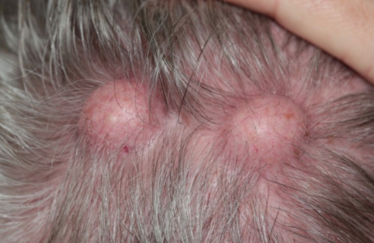mole treatment Costa Mesa CA