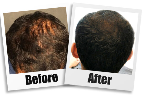 prp hair loss treatment center New Jersey
