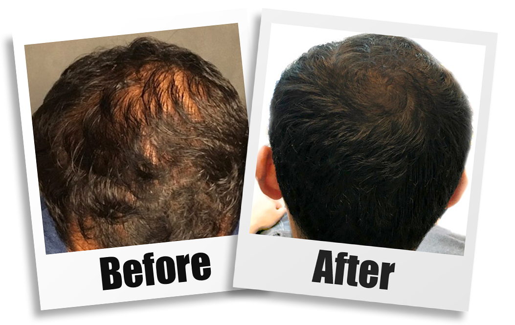 prp hair loss treatment center New Jersey